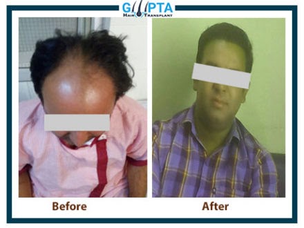 Hair Transplant In Ludhiana: Restoring Confidence: Hair Transplants in Ludhiana, Punjab