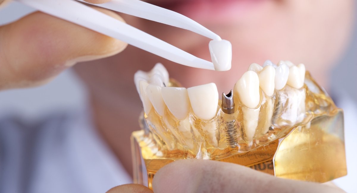 Getting Value for Your Money: How to Help Your Dental Implants Last?Blog Hub