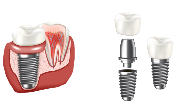 mexico tijuana dental implants dentist in mexico