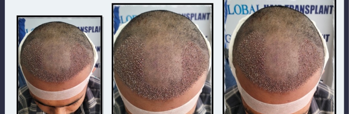 Global Hair Transplant