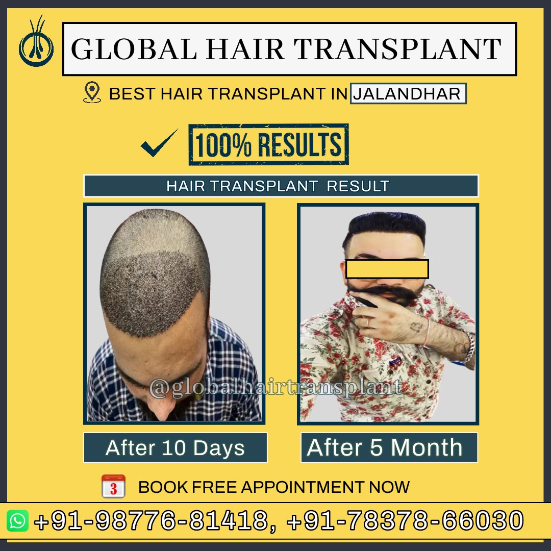 Global Hair Transplant